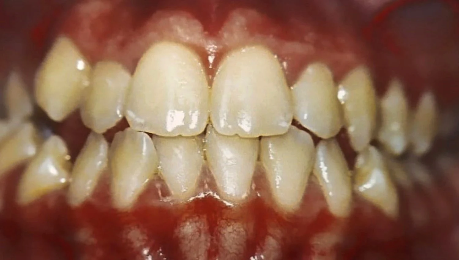 Arcada com dentes encavalados no início do tratamento